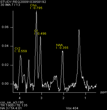 Figura 1.2 Spettroscopia RM del distretto cerebrale.