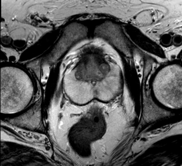 Figura 1.11 Anatomia della prostata individuata tramite una sequenza di acquisizione in T2.