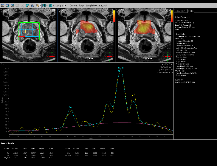 Figura 1.18 Tipico spettro da una prostata sana, con elevati valori di citrato e bassi valori di colina. Si noti la voxelizzazione della prostata (prima figura in alto a sinistra) in 30 zone.