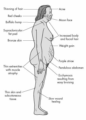 SINDROME DI CUSHING: CLINICA Irsutismo, acne, seborrea ed alterazioni della funzione mestruale