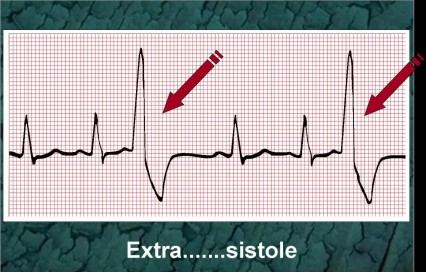 Aritmie Sono anomalie del ritmo cardiaco, che si manifestano occasionalmente o continuativamente.