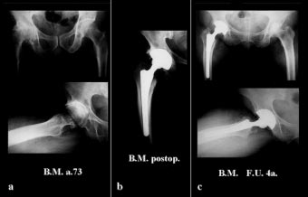 G. De Giorgi, et al. sia (4 casi), a necrosi cefalica (1 caso) e la frattura mediale di collo femorale (casi 5). Il lato prevalentemente interessato è stato il destro (31 casi).