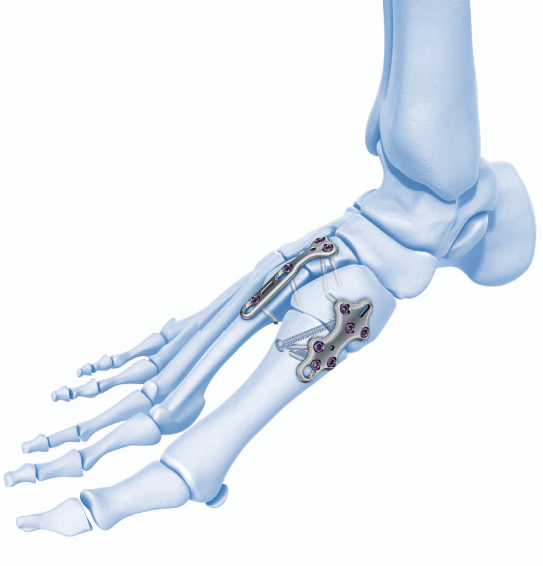 Placche di fusione TMT Per la fusione della 2a e 3a articolazione TMT Premodellate per adattarsi all anatomia Una misura Placca di fusione 1a TMT Placche anatomiche, a profilo basso studiate