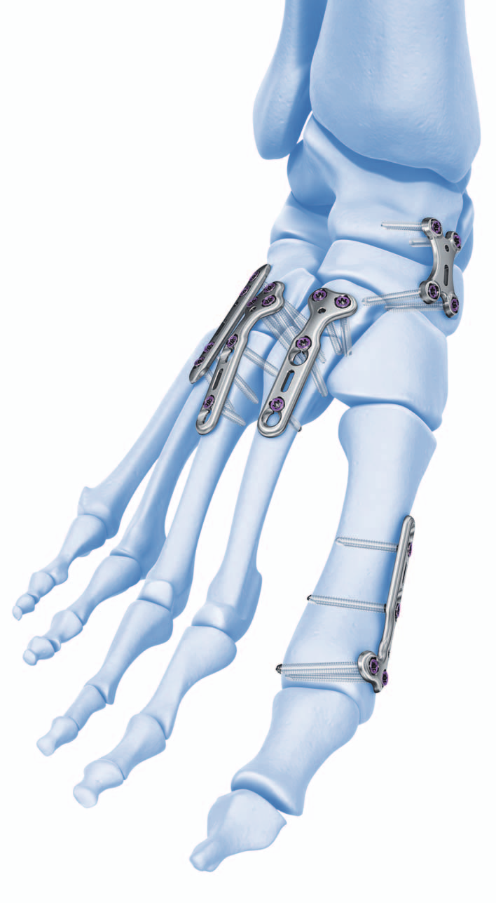 Le placche di fusione generali sono composte da viti di bloccaggio ad angolo variabile e hanno una funzione di compressione per supportare la chirurgia ricostruttiva del piede.