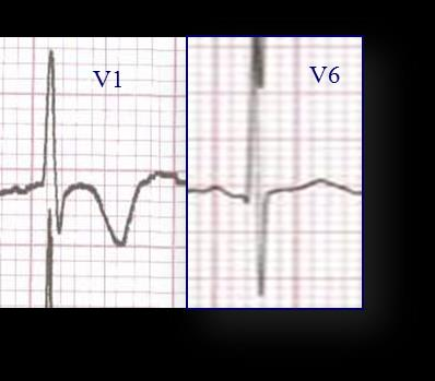 Asse Elettrico e morfologia complesso QRS nelle derivazioni