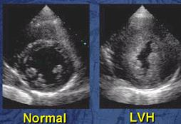 QRS? Perchè quando le pareti cardiache si