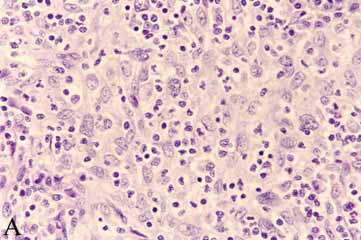 FIGURA 2 - Milza, nodulo fibroistocitario A) Istotipo.