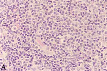 Proliferazione di una popolazione linfoide eterogenea comprensiva di occasionali cellule macronucleolate sparse (H&E, 40x) B) Citotipo correlato: blasti della serie linfoide di dimensioni medio