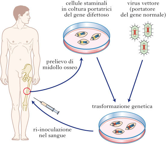 Trattamento che consiste nel sostituire un gene difettoso dal punto di vista funzionale con uno normale.