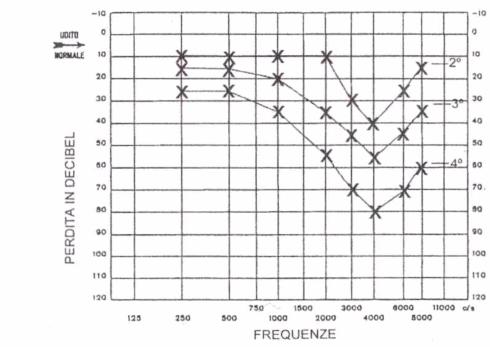 TRACCIATI AUDIOMETRICI CARATTERISTICI DI TRE STADI EVOLUTIVI DEL DANNO UDITIVO DA RUMORE LA SENSIBILITÀ AL RUMORE HA UNA