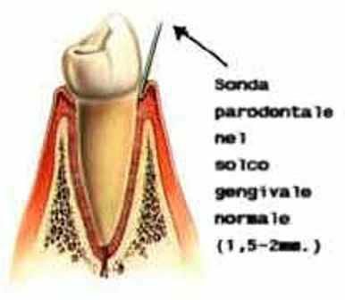 un'ulteriore riprova che non conta per niente la quantità ma la qualità dell'igiene orale. E' quindi necessario che i pazienti imparino la tecnica corretta di spazzolamento Cos'è il solco gengivale?