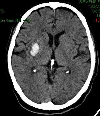 EMORRAGIA CEREBRALE Nella fase acuta la lesione emorragica