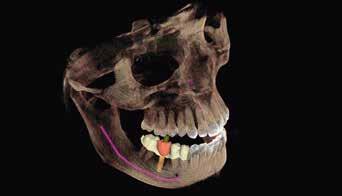 Facescanner integrabile Durante l'acquisizione della radiografia, il Facescanner integrabile opzionalmente traccia l'immagine virtuale del volto del