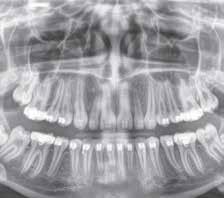 Nei casi più complessi e per l endodonzia, la modalità HD permette di ottenere immagini estremamente dettagliate.