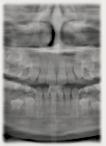 Radiografie panoramiche Mascella Seno mascellare