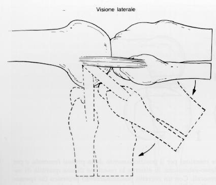Il componente femorale della protesi GSP ha i condili con profilo sagittale a raggio di curvatura