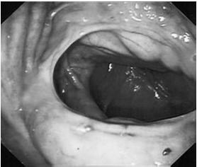 emorragie sotto mucosali EMORRAGICO o Traumi nasali o Polipi nasali o Neoplasie (nasali e/o seni) o Corpi estranei MENO COMUNI o Patologie dell emostasi trombocitopenia idiopatica trombocitopenia