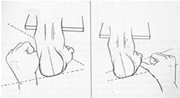 A B La supinazione dell'articolazione sottoastragalica riduce l'arco totale di movimento della articolazione mediotarsica