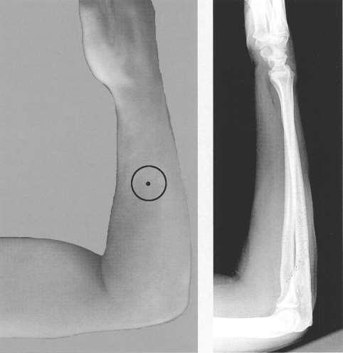 Avambraccio: PROIEZIONE LATERALE (o radio-ulnare) Posizione del paziente e risultato radiografico Criteri correttezza Radio e ulna sovrapposti