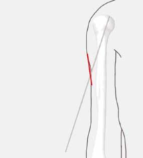 Fig. 4 4. Accesso e incisione Per la localizzazione del punto di ingresso il braccio viene leggermente extraruotato, in modo che il grande tuberosità venga ben evidenziato.