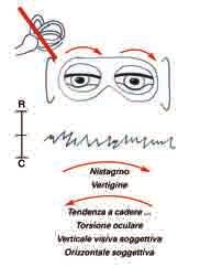 Manzari DVI: il modello patogenetico virale Prende corpo pertanto l ipotesi che in queste patologie si possa verificare una primitiva infezione virale dei neuroni del ganglio vestibolare.