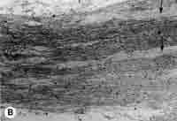 Il ganglio vestibolare inferiore nell osso temporale di una donna di 75 anni dimostra la transizione delle cellule nervose che vengono dapprima circondate e quindi sostituite dalle cellule satelliti