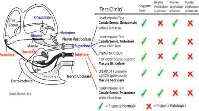 Manzari e Curthoys Test con VEMPs oculari per la diagnosi selettiva di danno otolitico bilaterale della funzione vestibolare presentavano invece un blink assolutamente normale, una funzione del VII