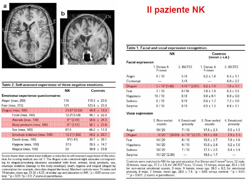 Caso clinico: paziente NK con esteso danno a carico dell insula sinistra e regioni circostanti da emorragia cerebrale.