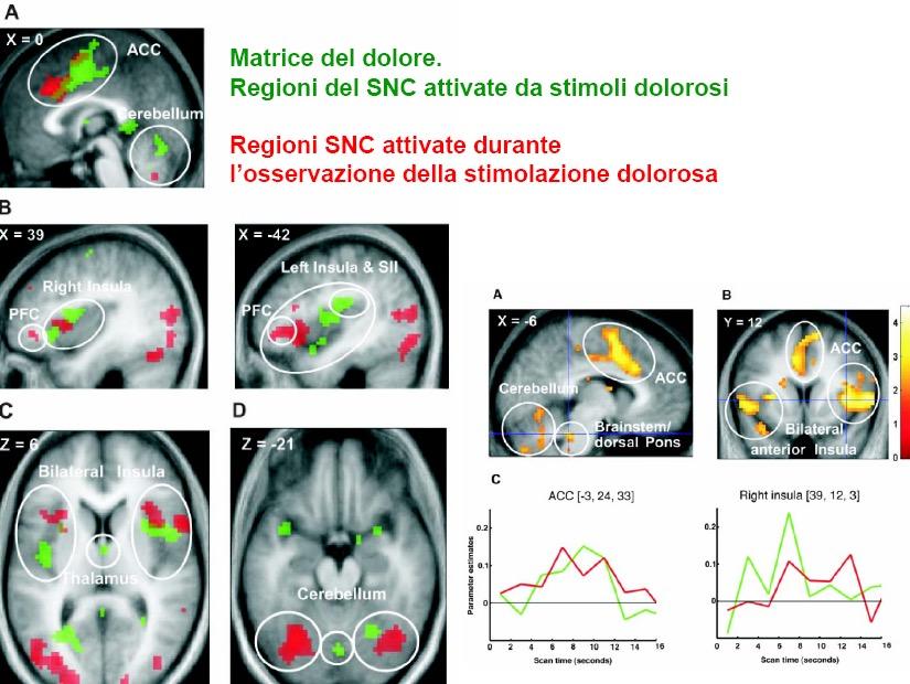 Nelle due condizioni sperimentali (stimoli dolorosi e osservazione della loro applicazione ad altri) si attivano: - Insula anteriore - Corteccia del cigolo La