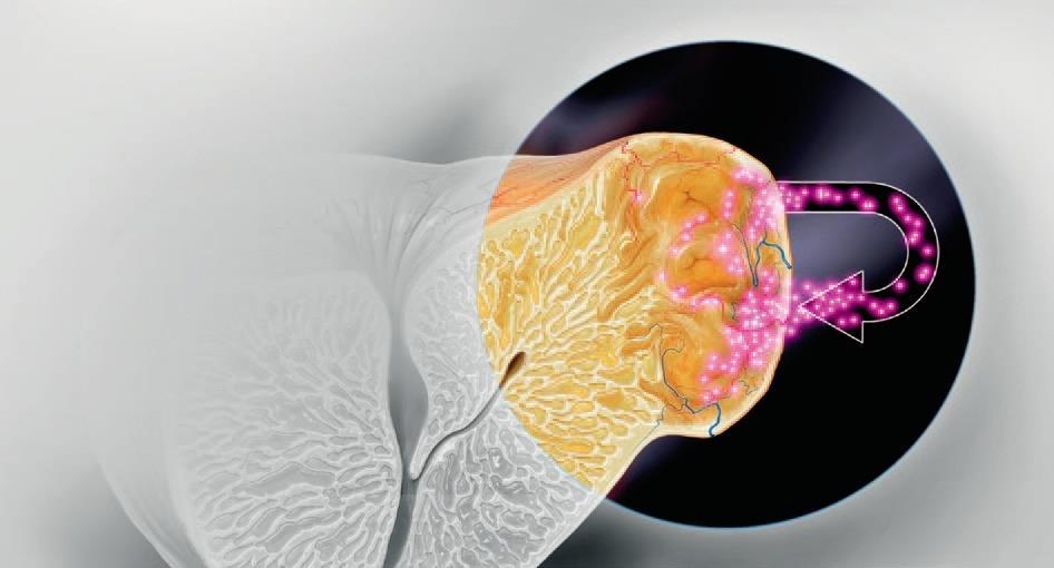 Nella fase CRPC le cellule tumorali iniziano ad Autoprodurre il Testosterone TUMORE PROSTATA Auto-produzione di testosterone nelle cellule tumorali aumento degli enzimi coinvolti nella produzione di