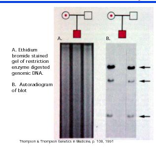 Diagnosi della sindrome da androgeno resistenza per mezzo dell analisi del Southern blot Il DNA dal gel di agarosio è stato trasferito su nitrocellulosa ed ibridizzato alla sonda cdna di un recettore