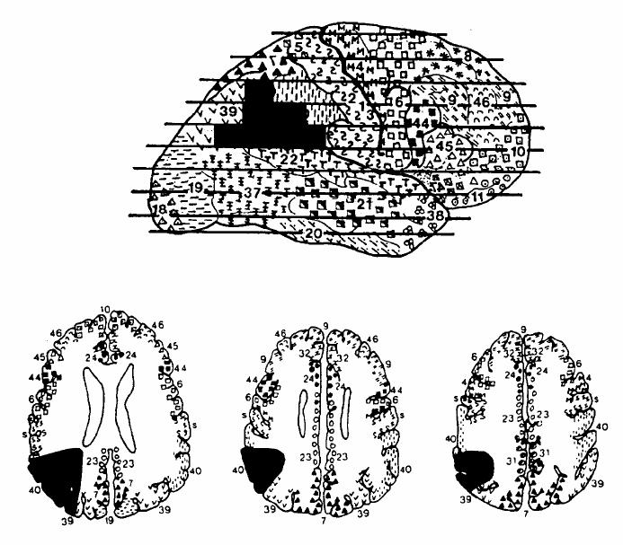 Evidenze neuropsicologiche indicano che i disturbi di calcolo acquisiti conseguono prevalentemente a lesioni