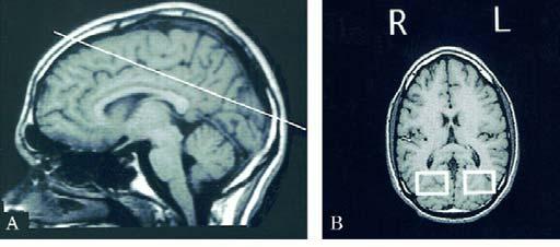 DE: Correlati neurali Anormalità metaboliche a livello dell