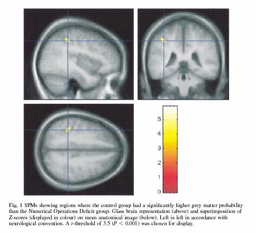 DE: Correlati neurali Soggetti DE presentano una riduzione di sostanza grigia