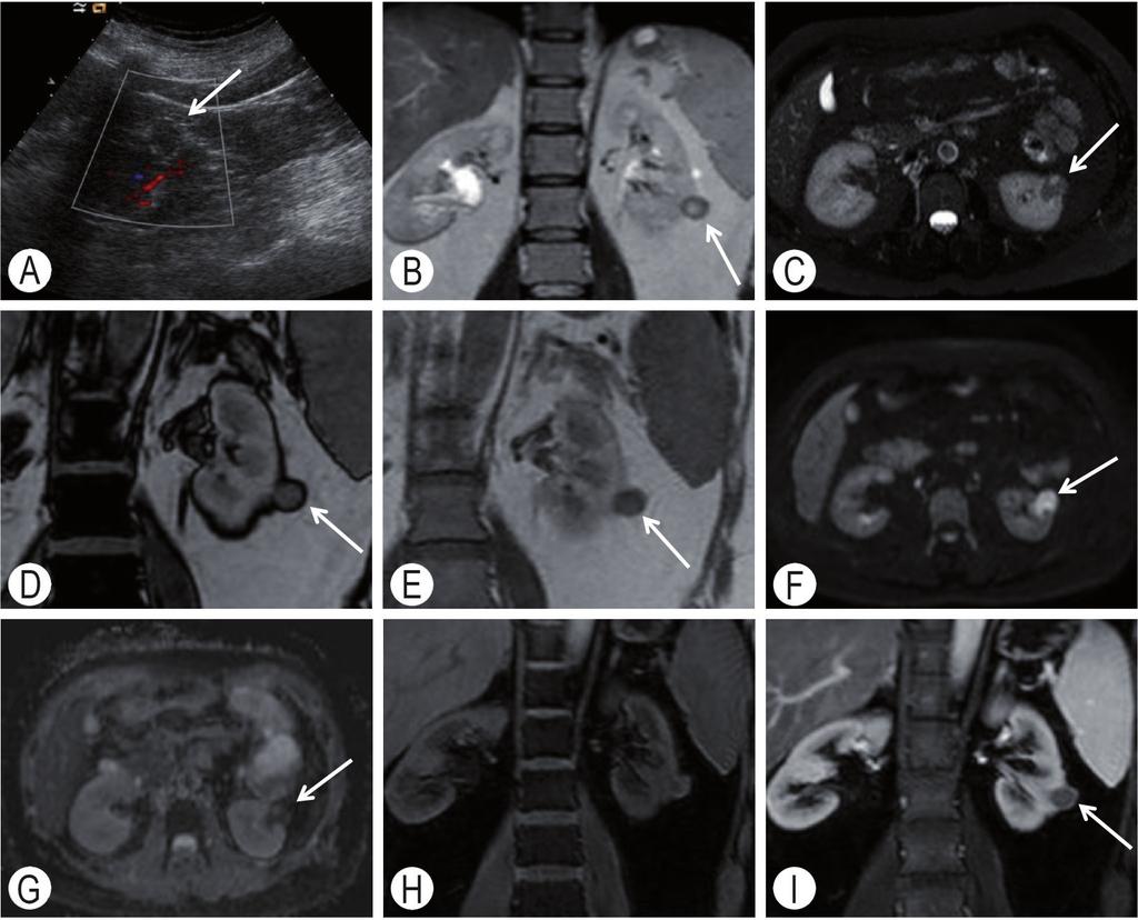 40 Il carcinoma renale: basi molecolari, biologiche e cliniche Figura 5.4 Carcinoma papillifero del rene di sinistra «stadio T1a». Neoformazione di 2 cm di riscontro incidentale [freccia (A-F)].