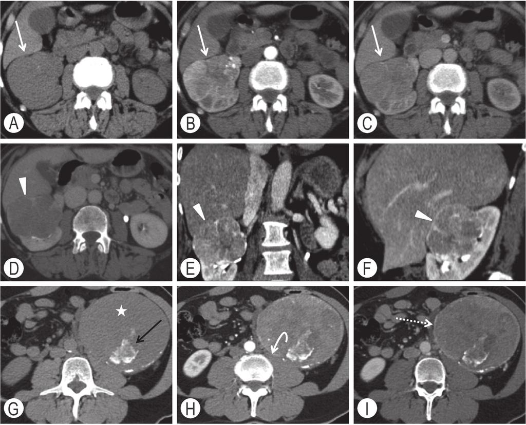 44 Il carcinoma renale: basi molecolari, biologiche e cliniche Figura 5.7 Carcinoma del rene «stadio T2». Primo caso («stadio T2a»).