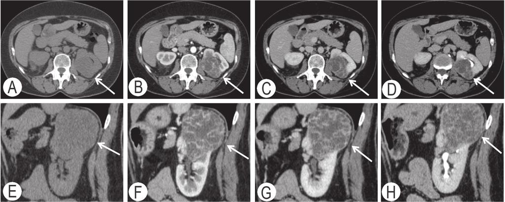 (D, H). In fase pre-contrastografica, la lesione appare isodensa/ isointensa al parenchima renale sano adiacente, con minute calcificazioni nel suo contesto (A).