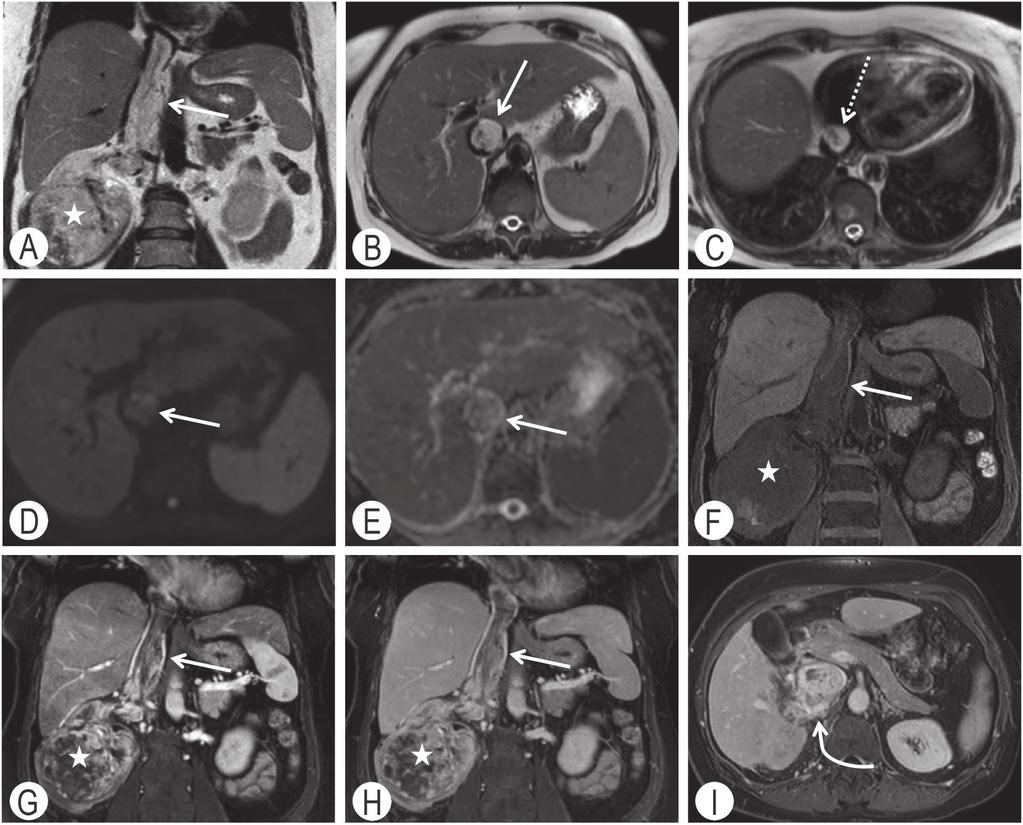 Diagnostica per immagini e stadiazione clinica 47 Figura 5.11 Carcinoma a cellule chiare del rene di destra «stadio T3c».