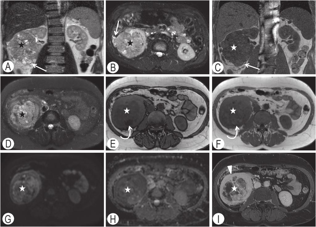 48 Il carcinoma renale: basi molecolari, biologiche e cliniche Figura 5.12 Carcinoma a cellule chiare del rene «stadio T4». Primo caso [stella (A-C)].