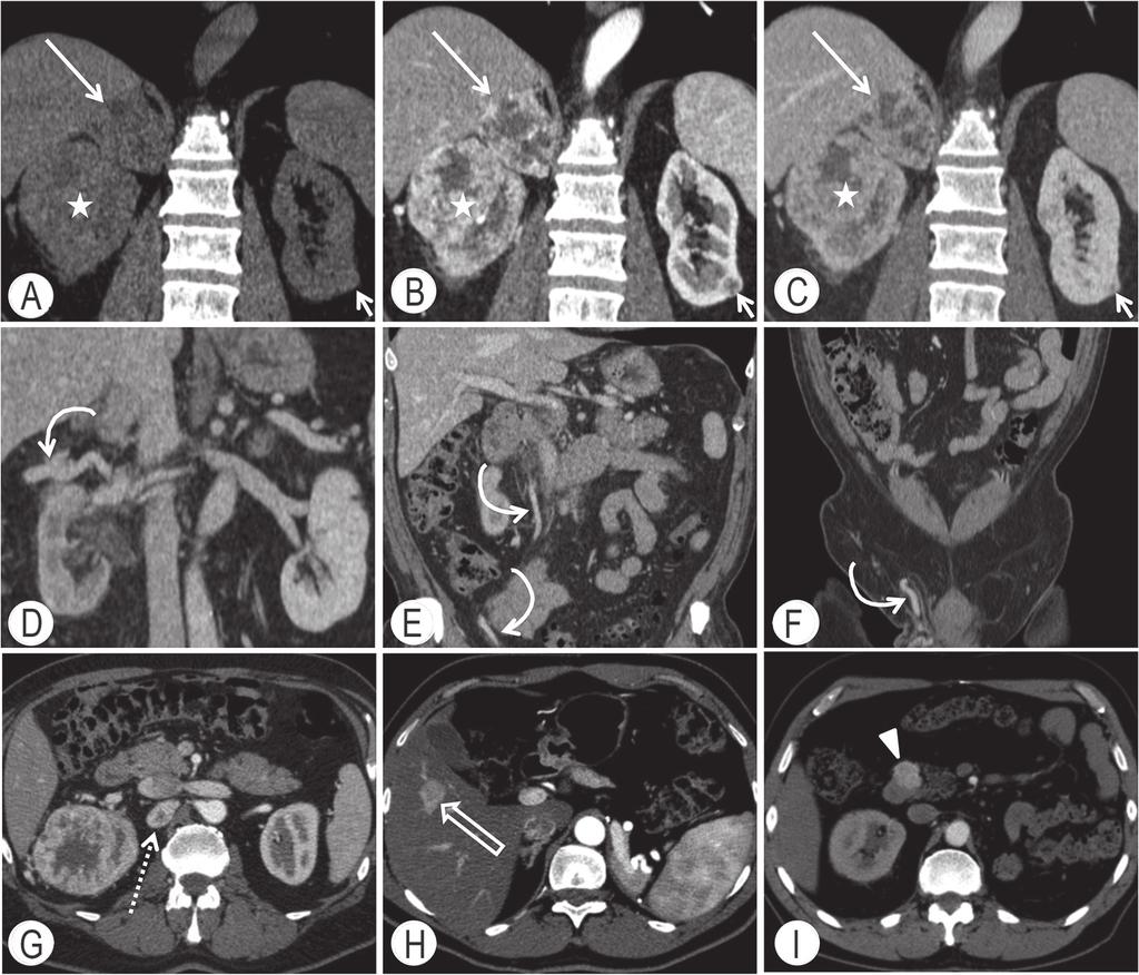 Diagnostica per immagini e stadiazione clinica 49 Figura 5.13 Carcinoma del rene «stadio 4». Primo caso [stella (A-G)].