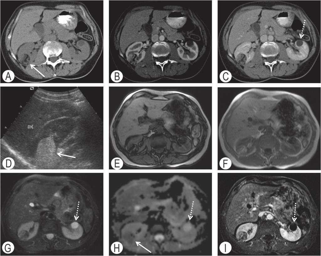 Diagnostica per immagini e stadiazione clinica 33 Figura 5.1 Angiomiolipoma del terzo medio del rene di destra (freccia).