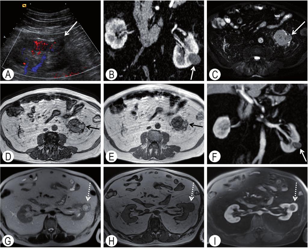 Diagnostica per immagini e stadiazione clinica 39 Figura 5.3 Carcinoma a cellule chiare del rene di sinistra «stadio T1a». Primo caso, neoformazione di 2,5 cm [freccia (A-F)].