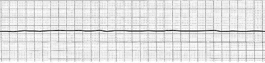 Asistolia: Non vi è alcun impulso elettrico. Bibliografia/Sitografia Fedele, F. (2011). Corso base di interpretazione e lettura dell'ecg per l'infermiere.