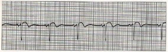 Complesso QRS: di aspetto normale, ciascuno di essi segue un onda P Intervallo QRS: 0.06 secondi. Onda T: segue ciascun complesso QRS ed è positiva.