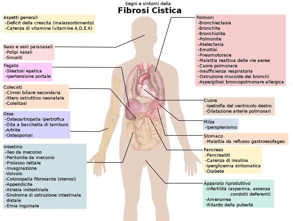Figura 1 Manifestazioni cliniche della fibrosi cistica a livello dei vari organi.