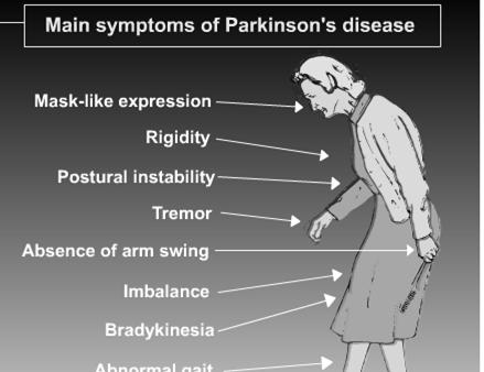 Sintomi principali: Bradicinesia (rallentamento e limitazioni dei movimenti); Rigidita'