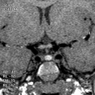 GHD (2) Pituitary Aplasia