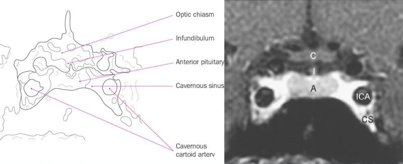 Risonanza magnetica cerebrale con normale morfologia dell area ipotalamo-ipofisaria (sezione