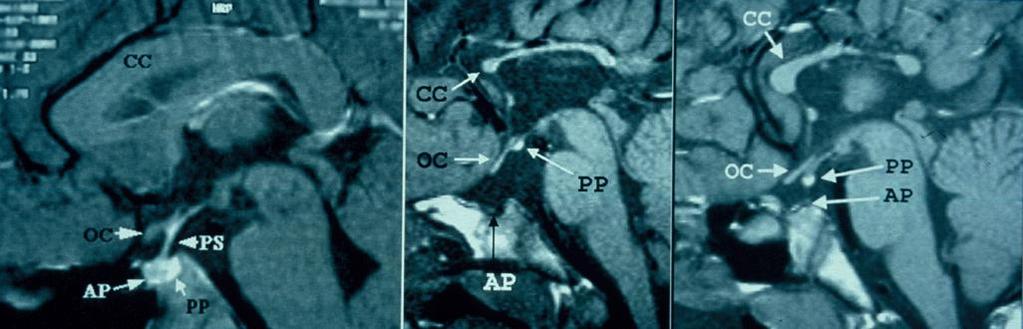 Neuroimaging nelle mutazioni di