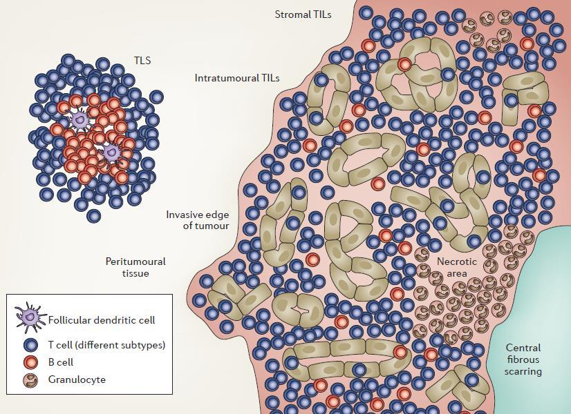 TILs The evaluation of TILs in breast cancer: recommendations by an International TILs Working Group 2014 Full sections preferred over biopsies Stromal TILs reported as % No formal TILs